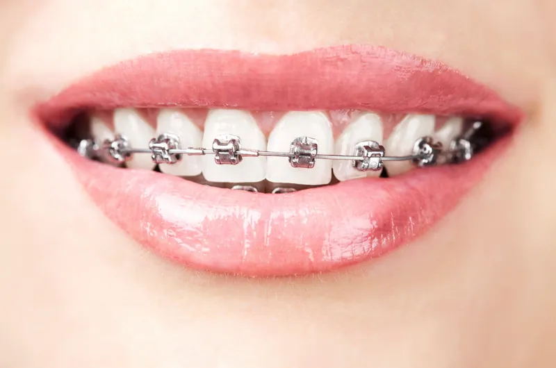 Niềng răng Nhổn uy tín tại Phố Nhổn